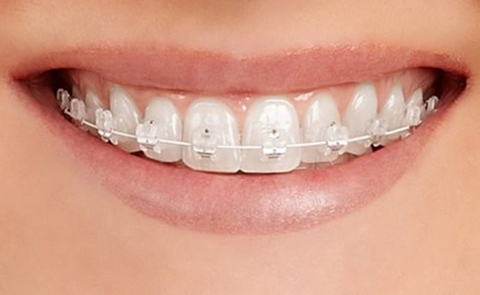 Tooth-coloured ceramic braces on a patient's teeth