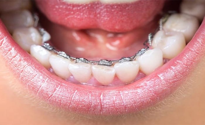 Lingual braces fixed to the inner side of the teeth