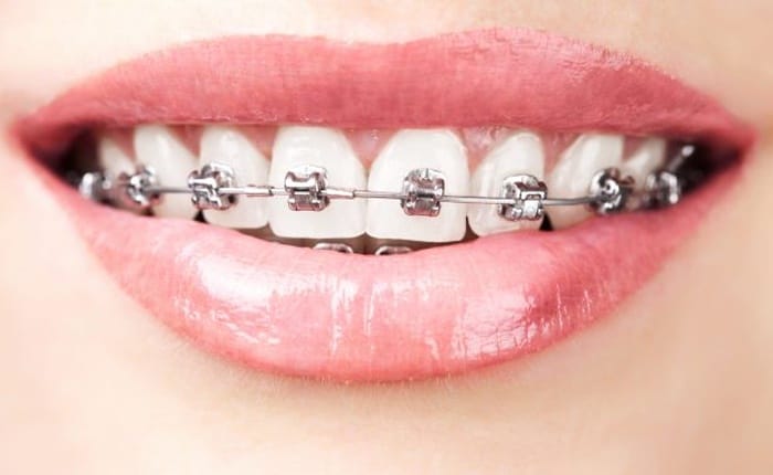 Metal braces on a patient's teeth