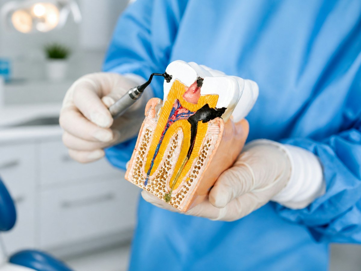 Dentist showing a patient a model of a damaged tooth to explain root canal treatment