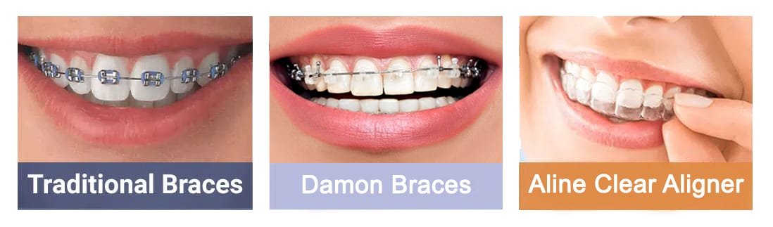 Best Options for Your Teeth Straightening and Alignment in Dubai - Braces, Damon Braces and Aline Clear Aligner